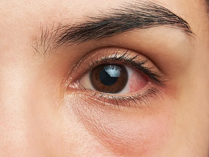 Can You Wear Contacts With A Stye Here's The Answer
